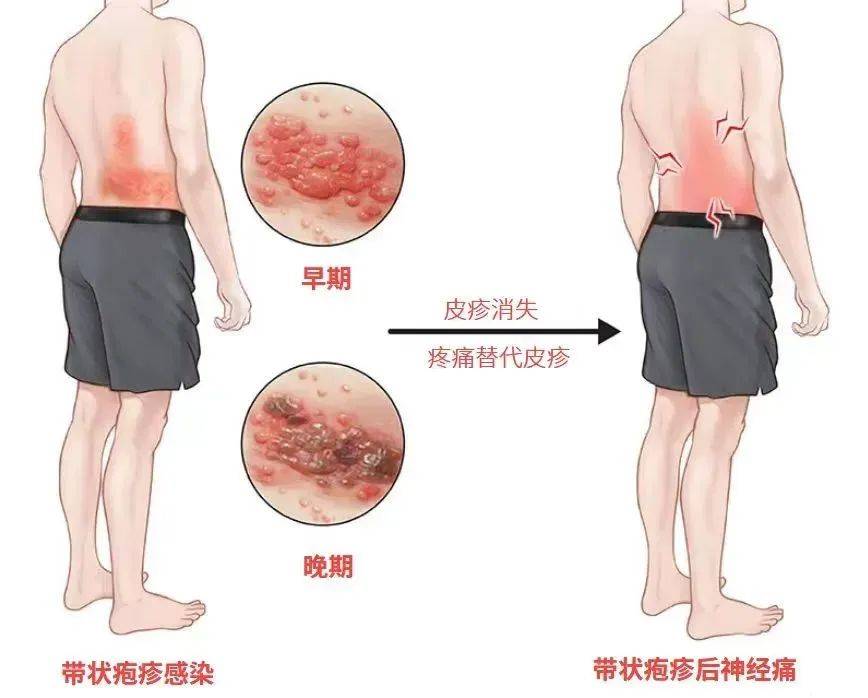 一旦感染终身携带<strong></p>
<p>币圈砸盘</strong>！深圳疾控提醒：这4类人要注意