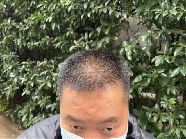 “还能反光<strong></p>
<p>桔子币</strong>！”长沙男子植发近9月称后脑勺“像狗啃过”