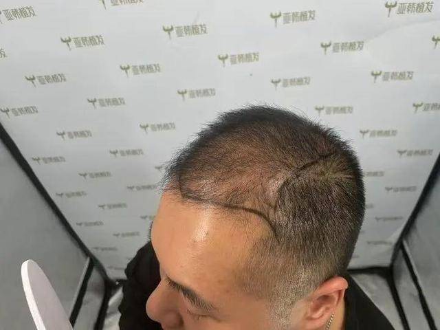 “还能反光<strong></p>
<p>桔子币</strong>！”长沙男子植发近9月称后脑勺“像狗啃过”
