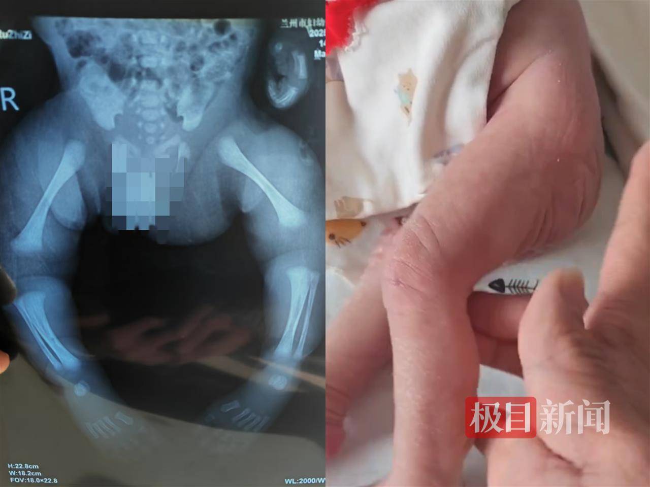 二胎出生查出先天性病症或落下残疾<strong></p>
<p>百链币</strong>，残疾父母称医院产检漏检、未尽告知义务，医院及医调委回应