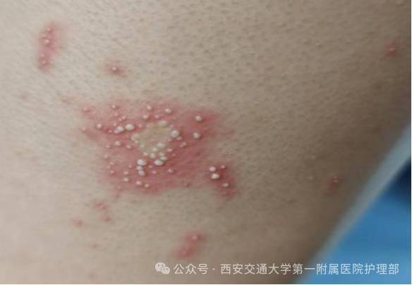 西安多区发现隐翅虫？千万别拍<strong></p>
<p>aave</strong>！毒液堪比硫酸