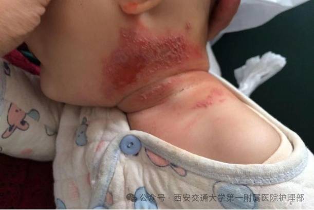 西安多区发现隐翅虫？千万别拍<strong></p>
<p>aave</strong>！毒液堪比硫酸