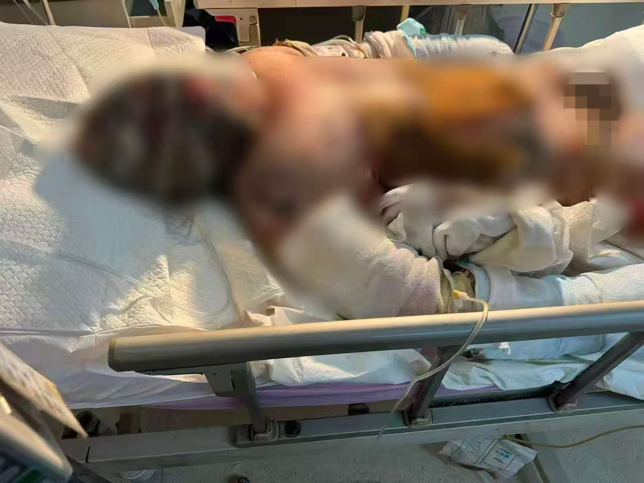 父子在哈尔滨一亲戚公司上班遇爆炸全身烧伤<strong></p>
<p>DAI</strong>，治疗花费近百万公司拒赔偿？亲戚回应