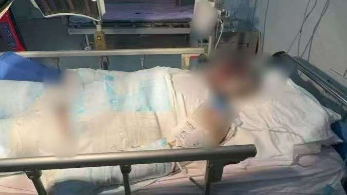 父子在哈尔滨一亲戚公司上班遇爆炸全身烧伤<strong></p>
<p>DAI</strong>，治疗花费近百万公司拒赔偿？亲戚回应