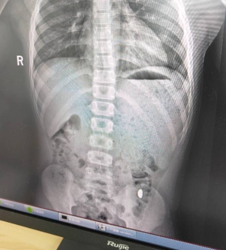 “熊孩子”误吞10克重金豆<strong></p>
<p>hbar币</strong>,妈妈:天天叮嘱他不要在外面拉屎