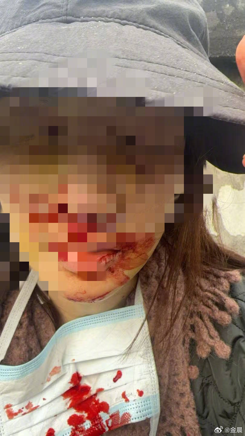 警方发布警情通报后<strong></p>
<p>btc价格今日行情</strong>，金晨晒脸部受伤照片并发文道歉